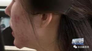 美女祛痘呗(广西20岁美女祛痘不成反“烂脸”要索赔美容院：放弃治疗后果自负)